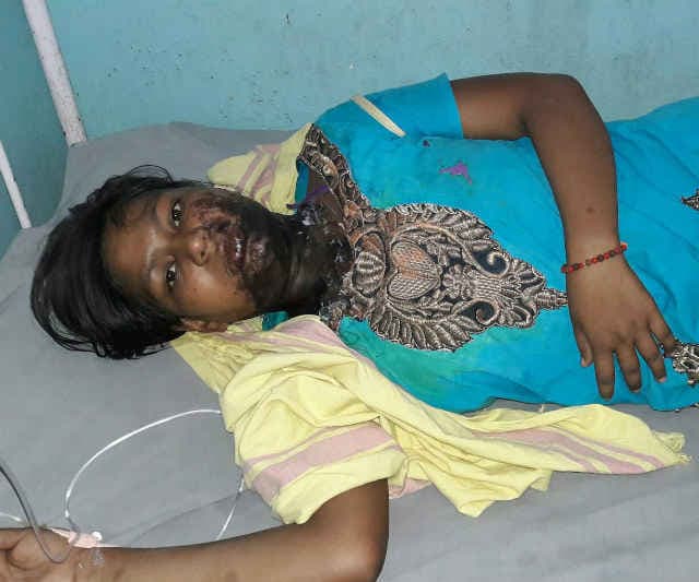 झारखंड के गिरिडीह जिले में कस्तूरबा विद्यालय की दो छात्राओं पर तेजाब फेंका