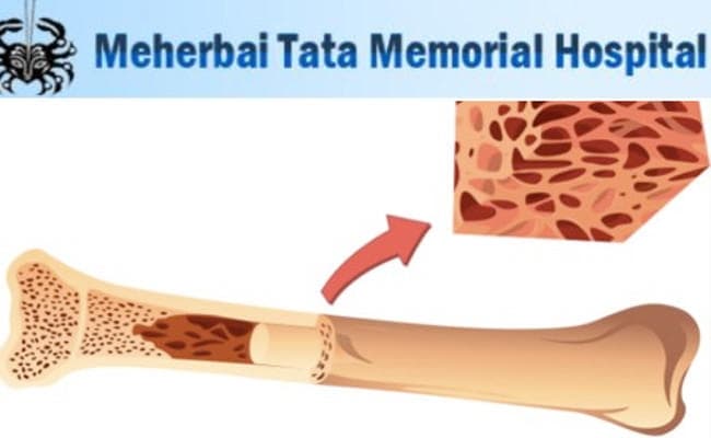 बोन मैरो ट्रांसप्लांट अब झारखंड में, जमशेदपुर के मेहरबाई टाटा अस्पताल में जल्द शुरू होगी सुविधा