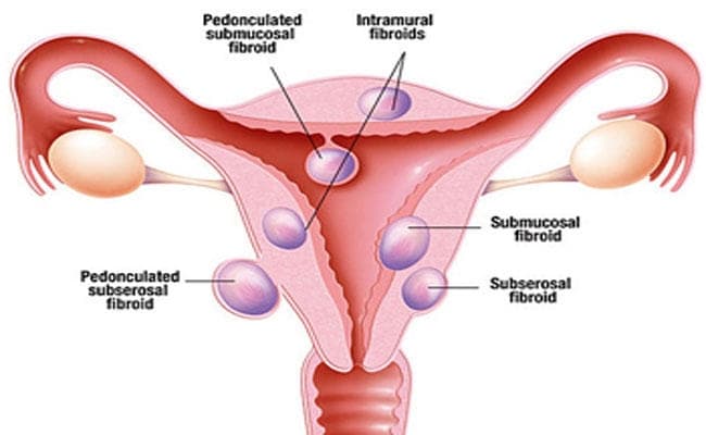 फाइब्राइड : महिलाओं की गंभीर समस्या