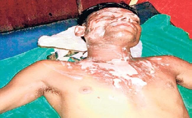 सिक्का देने की जिद पर दुकानदार ने उड़ेला खौलता तेज, 3 झुलसे