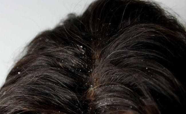 करी पत्ता से दूर करें डैंड्रफ की परेशानी