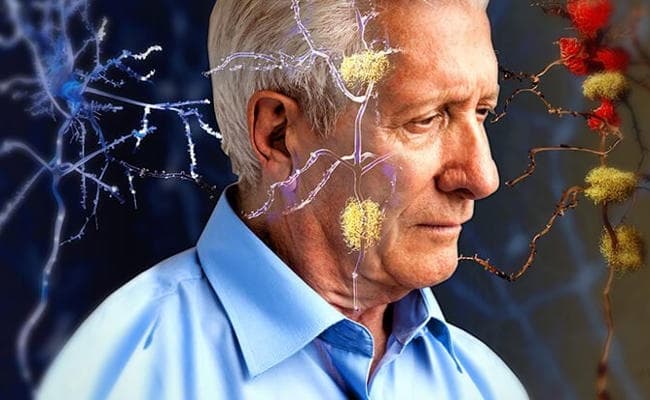 खून की जांच से अल्जाइमर का पता चल सकता है