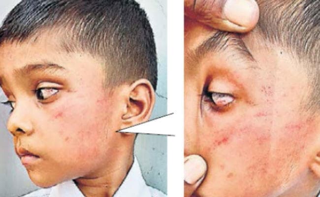 रांची : होमवर्क नहीं बनाने पर नर्सरी के बच्चे को पीटा गाल व आंख में जख्म