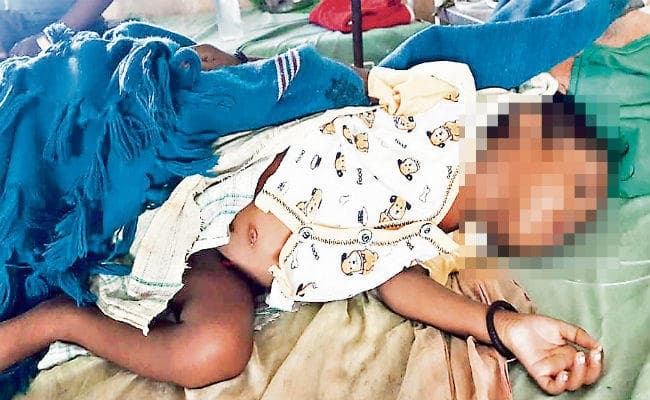 रांची : कुपोषित है दो साल की जूही, वजन केवल छह किलो, रिम्स में चल रहा इलाज