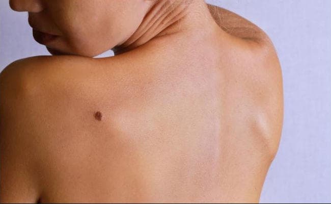 Breakthrough: मिल गया स्किन कैंसर का इलाज, पढ़ें पूरी खबर...