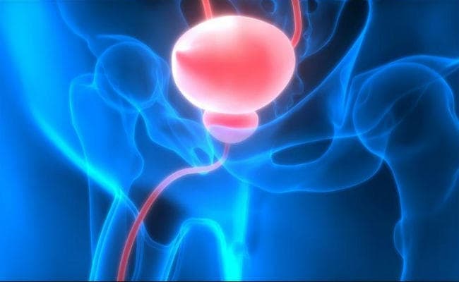 Health News: प्रोस्टेट की समस्याओं की पहचान के लिए स्मार्ट स्क्रीनिंग जरूरी