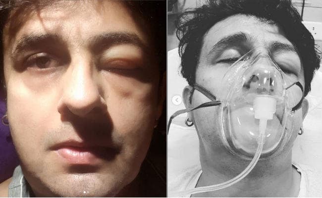 सोनू निगम को सी फूड खाने से हुई एलर्जी, ऐसी हो गई हालत