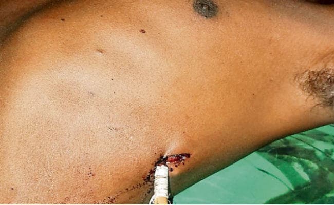 रांची : पेट में घुसा था तीर, रिम्स के डॉक्टरों ने बचायी जान