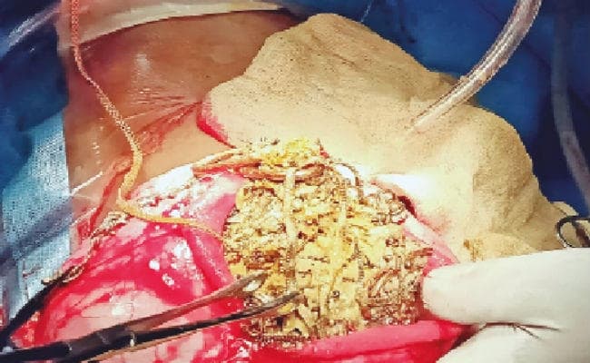 ऑपरेशन में पेट से निकले सोने-चांदी के 90 आभूषण और 10 सिक्के