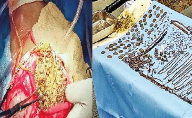 अनोखा ऑपरेशन : डॉक्टर भी रह गये हैरान, महिला के पेट से निकले सोने-चांदी के 90 आभूषण