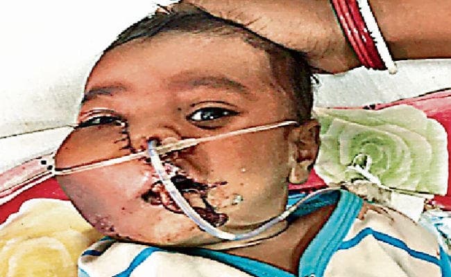 रांची : चार माह के बच्चे के चेहरे पर था ट्यूमर, हुई सफल सर्जरी