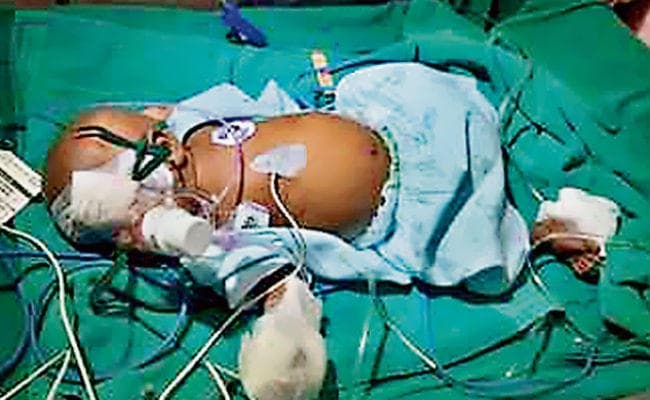 रांची : दो माह के बच्चे की आंखों का हुआ सफल ऑपरेशन