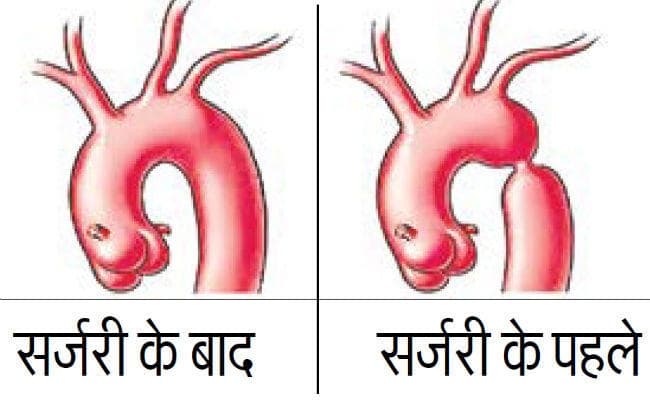 रिम्स : बिना चीरा ठीक हुआ महाधमनी का सिकुड़न