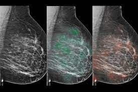 AI Mammogram: ब्रेस्ट कैंसर की स्क्रीनिंग इमेज पढ़ने में एआई सक्षम, स्टडी में सामने आयी यह बात AI Mammogram: ब्रेस्ट कैंसर की स्क्रीनिंग इमेज पढ़ने में एआई सक्षम, स्टडी में सामने आयी यह बात