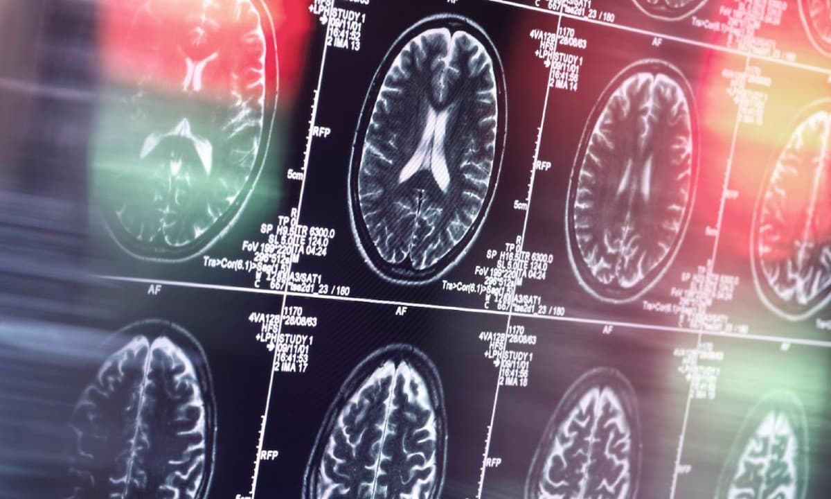 COVID रोगियों के तंत्रिका संबंधी विकारों की चपेट में आने का खतरा अधिक, अध्ययन में कही गई ये बात
