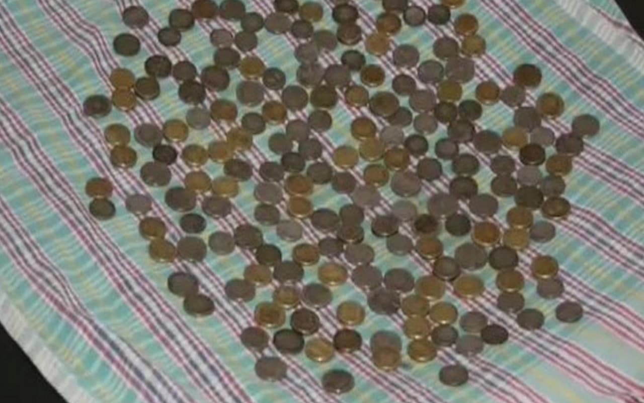 सर्जरी के दौरान पेट से निकाले गए 187 सिक्के, डॉक्टर भी हैरान, जानें क्या है मामला