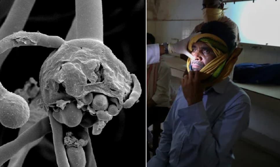 महिलाओं से ज्यादा पुरुषों को संक्रमित कर रहा Black Fungus, ज्यादातर Diabetes मरीजों को गंवानी पड़ रही जान, जानें अध्ययन में और क्या हुआ खुलासा महिलाओं से ज्यादा पुरुषों को संक्रमित कर रहा Black Fungus, ज्यादातर Diabetes मरीजों को गंवानी पड़ रही जान, जानें अध्ययन में और क्या हुआ खुलासा