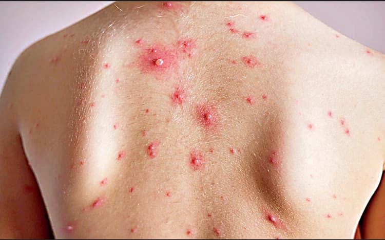 रांची में चिकन पॉक्स व खसरा की चपेट में आ रहे बच्चे, डॉक्टरों ने सावधान रहने की दी सलाह