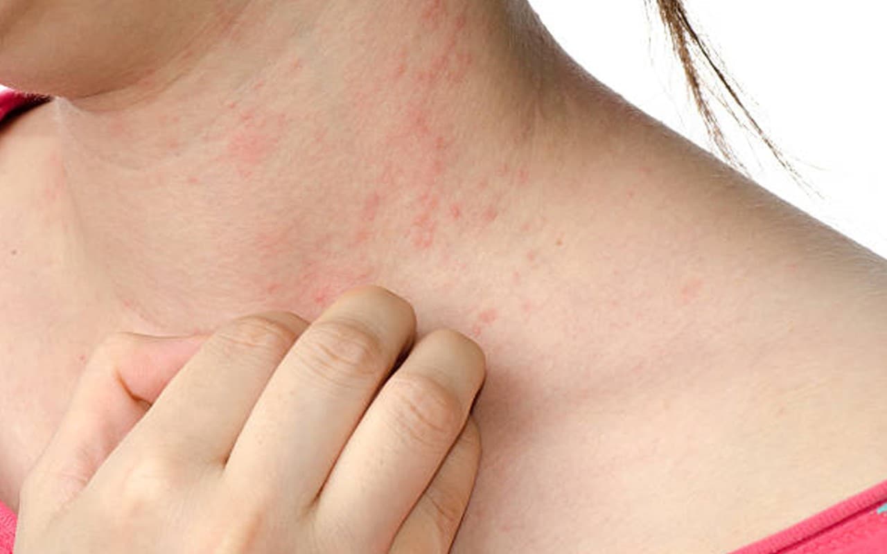 World Psoriasis Day: फास्टफूड खाने से होता है सोरायसिस? किशोरों और युवाओं में ज्यादा फैलती है ये बीमारी
