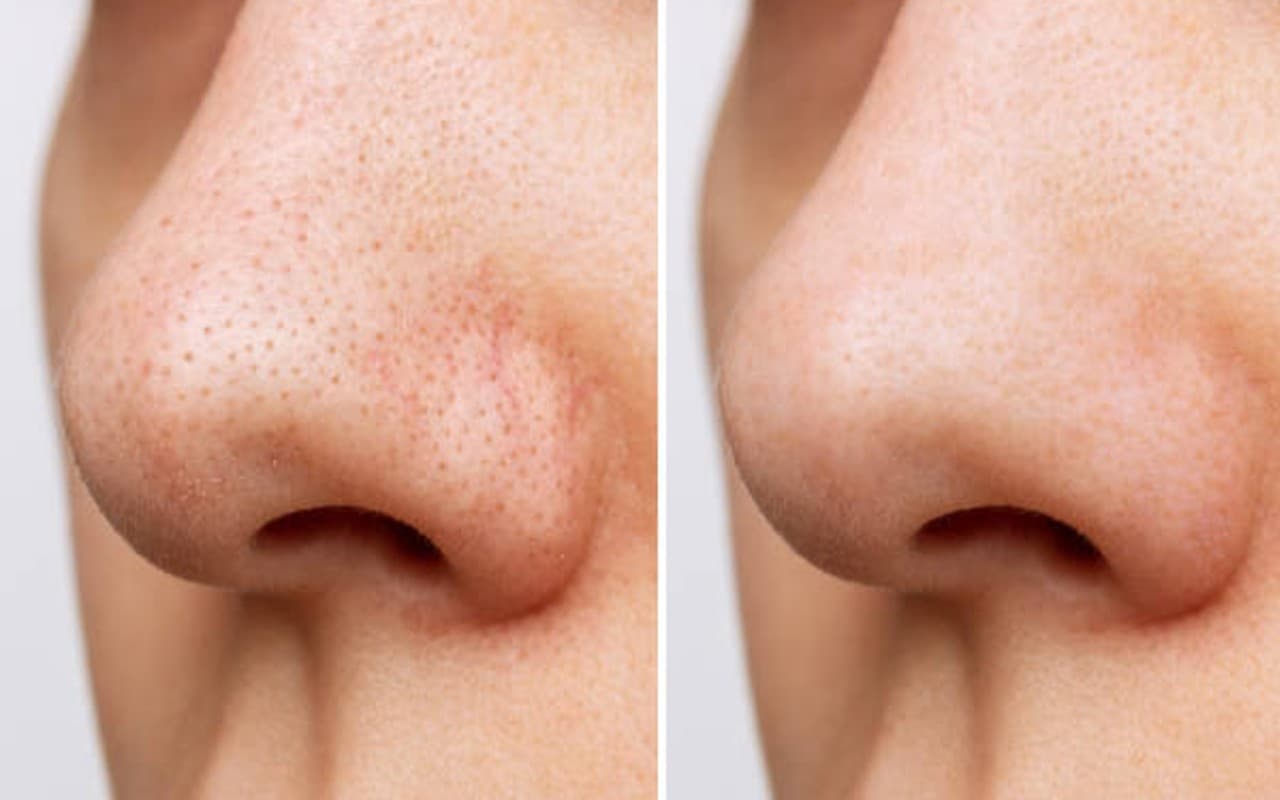 ब्लैकहेड्स की समस्या को घर बैठे करें दूर, ये हैं 6 आसान घरेलू तरीका