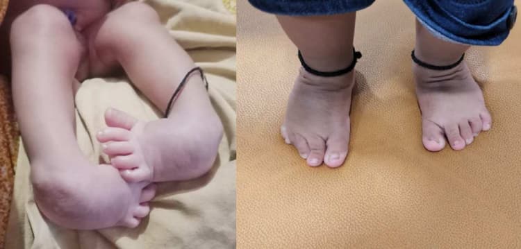 जन्म से मुड़े हुए दोनों पैर इलाज के बाद सीधे हो गए, अपंगता से पूरी तरह बाहर निकाला