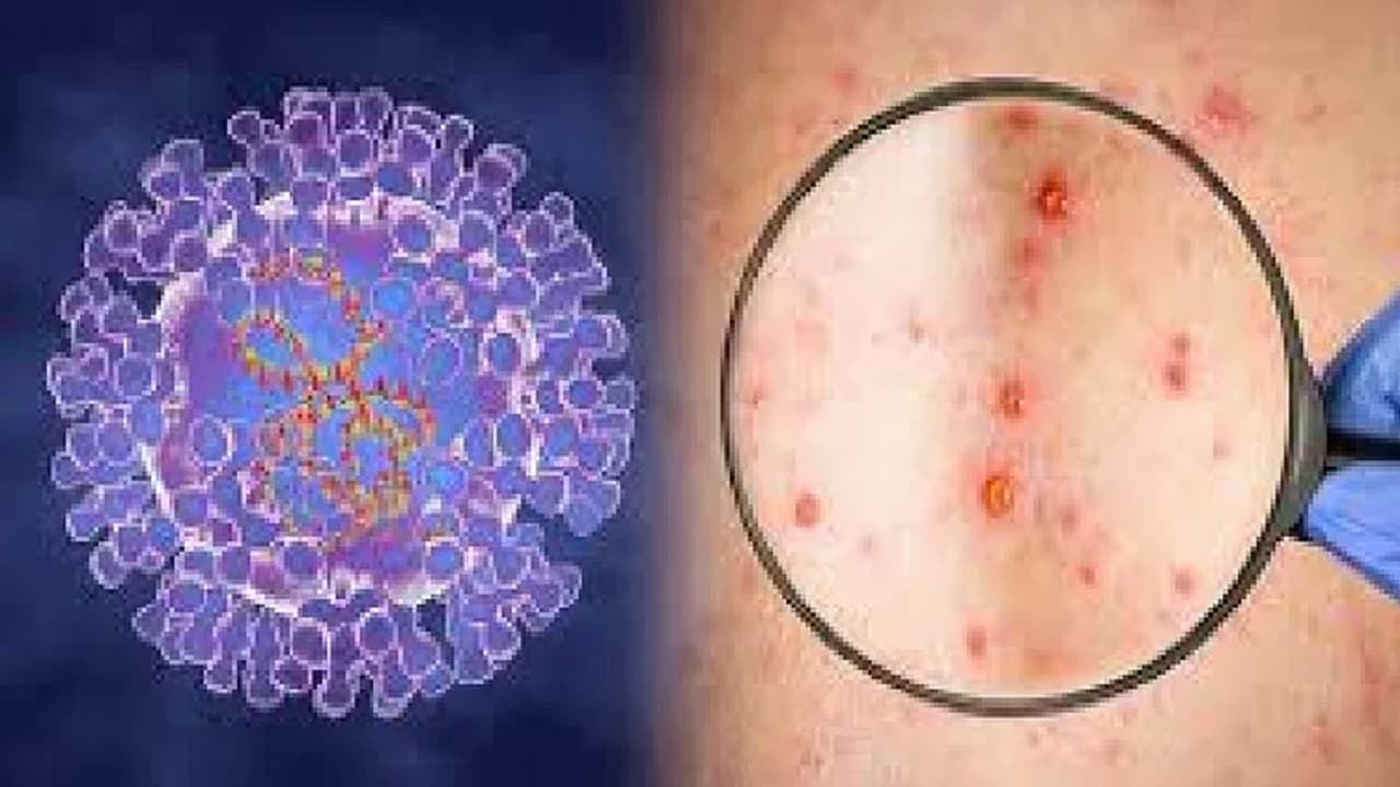 Monkeypox: दिल्ली में मंकीपॉक्स का चौथा मामला सामने आया, देश में अब तक 9 लोग पॉजिटिव