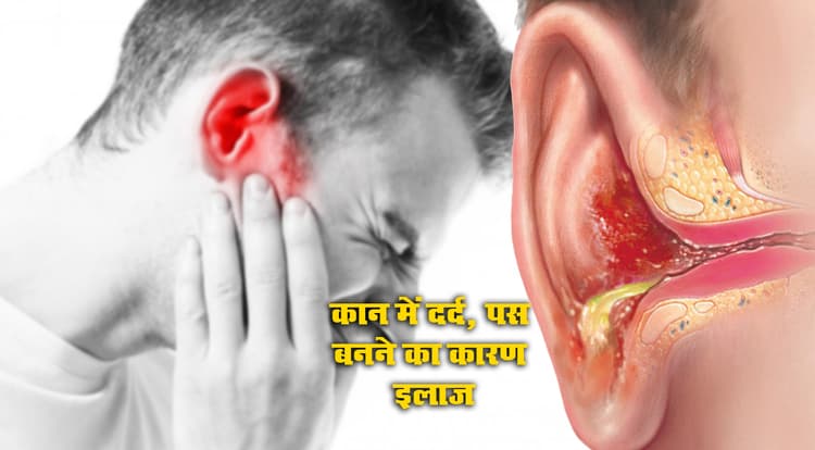 Ear Infection का किन्हें होता है खतरा, दर्द या पस बनने की समस्या से हैं परेशान तो पर्दे में छेद तक कर सकते है ये फंगल वायरस, जानें बचाव के उपाय