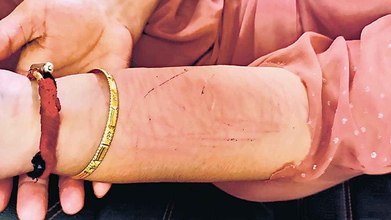 पटना में युवती के शरीर पर ब्लेड से काटकर लिखा' I HATE U', बेहोशी टूटी तो ट्रक में थे दो लड़के, और फिर...