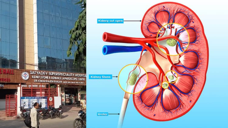 मासूम को दिया गया जीवनदान, यूरेटर से स्टोन को दूरबीन विधि से निकाला गया