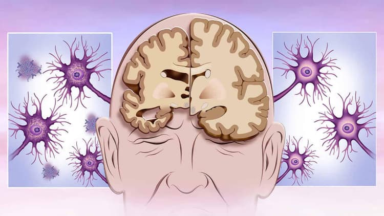 World Alzheimer's Day: आपके भूलने की आदत कहीं अल्जाइमर का संकेत तो नहीं ! जानें क्या है रोग के लक्षण