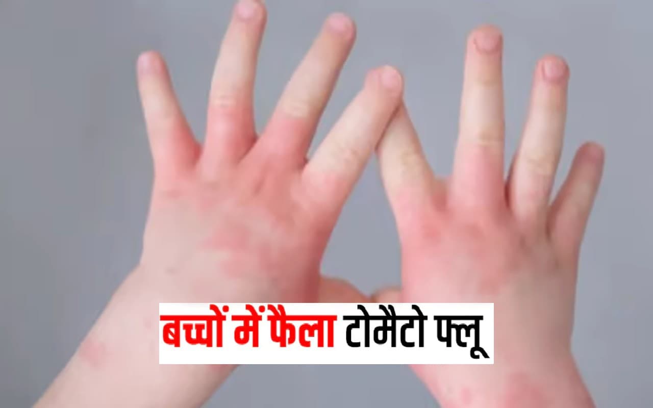 Explainer: भारत में Tomato flu का बढ़ा खतरा, जानें क्या हैं लक्षण और उपचार?