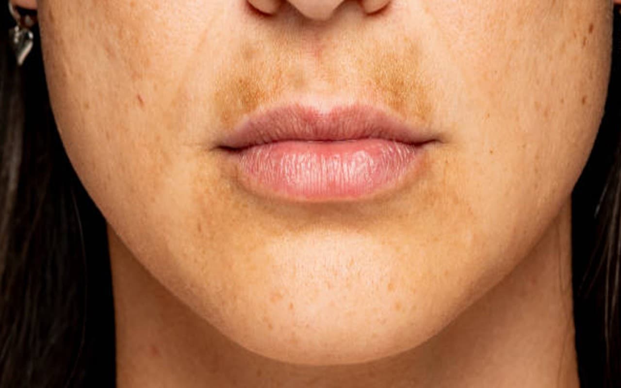 होंठों के ऊपर कालापन को चुटकी में करें दूर, ट्राई करें ये घरेलू नुस्खे