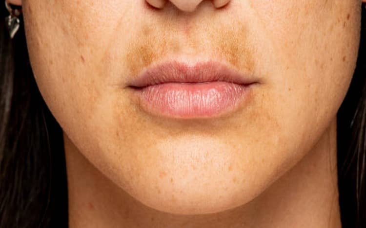 होंठों के ऊपर कालापन को चुटकी में करें दूर, ट्राई करें ये घरेलू नुस्खे