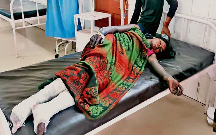 धनबाद के कुसुंडा में गर्म ओवर बर्डन की चपेट में आने से पांच लोग झुलसे, हालत गंभीर