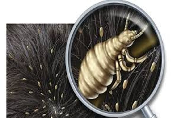 Home Remedies For Head Lice: अगर आप कई सालों से सिर में पड़े जुएं से हैं परेशान, तुरंत आजमाएं ये घरेलू उपाय