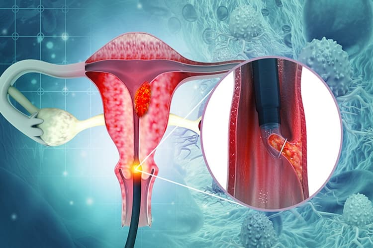 Cervical cancer: सर्वाइकल कैंसर क्या है? इसके बुनियादी तथ्यों को समझें