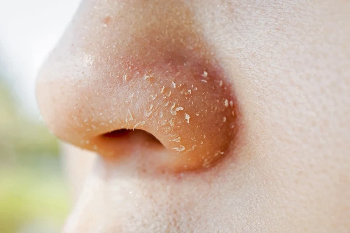 Skin Care Tips: क्या आपकी भी नाक के पास की स्किन ड्राई हो जाती है, जानें क्या हो सकते हैं कारण