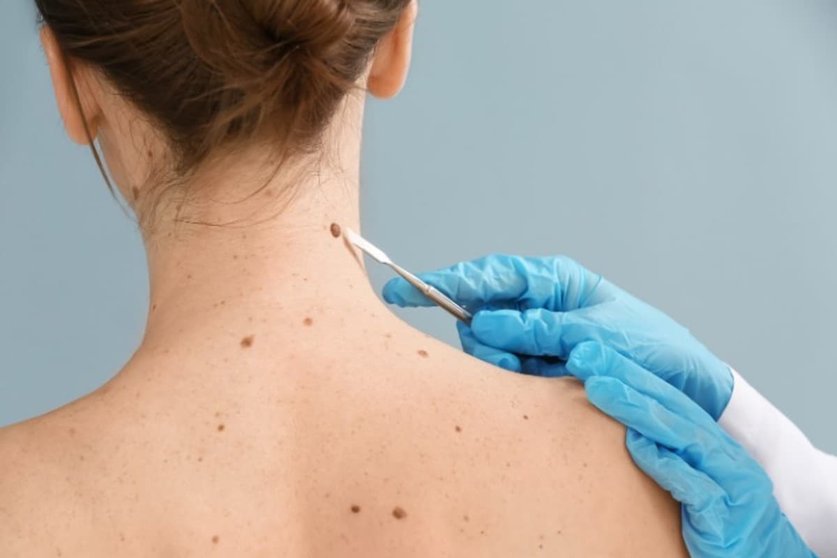 Skin cancer: करें अपनी त्वचा की देखभाल स्किन कैंसर के इलाज़ के बाद