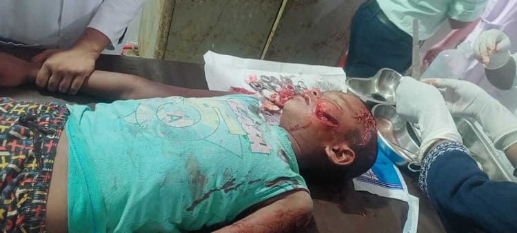 स्कॉर्पियो के धक्के से बालक घायल, भर्ती