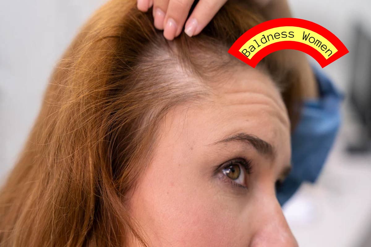 Baldness: महिलाओं में गंजापन दूर करने के घरेलू उपाय