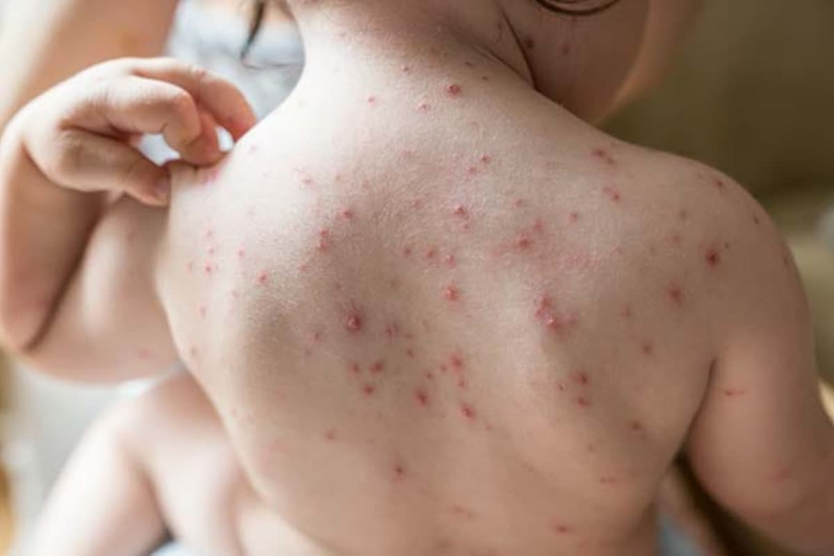 Chickenpox virus: चेचक के लिए कौन सा वायरस ज़िम्मेदार है?