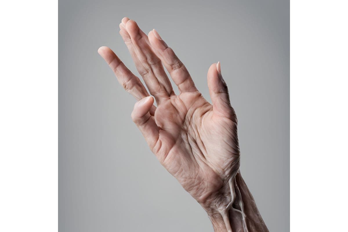 Vericose veins: वरिकोज़ वेन्स के कारण, लक्षण और उपचार को समझें