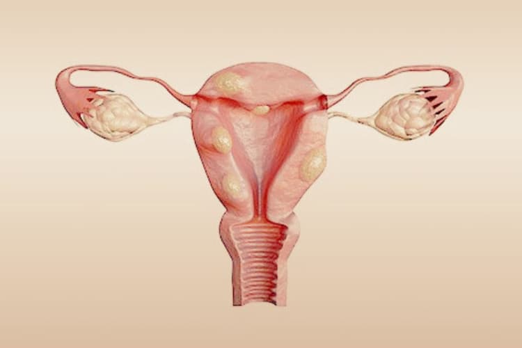 Uterine fibroids: गर्भाशय फाइब्रॉइड्स की वृद्धि को कैसे रोकें