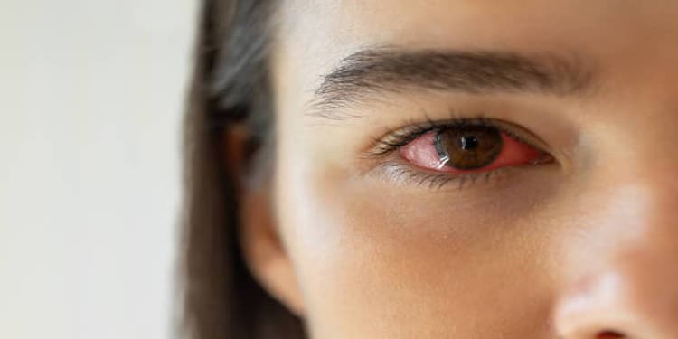 Eye Care in Monsoon: बरसात में फैलते कई तरह के संक्रमण, ऐसे करें अपनी आंखों की सुरक्षा