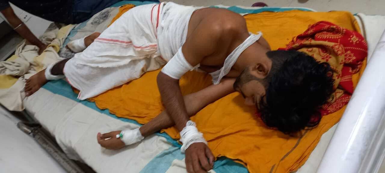 बड़े भाई ने छोटे भाई के उपर फेंका खौलता तेल, बुरी तरह झुलसा, अस्पताल में भर्ती