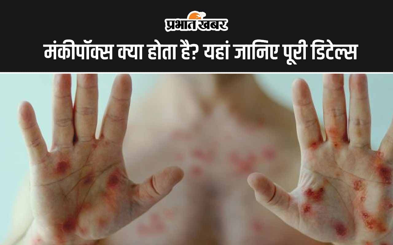 Monkeypox scare: मंकीपॉक्स क्या होता है? यह कैसे फैल रहा है, जानिए एमपॉक्स के लक्षण और बचाव के उपाय