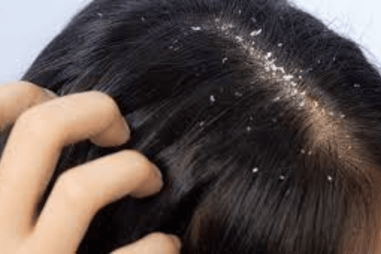 Dandruff Removal: डैंड्रफ से छुटकारा पाने के असरदार घरेलू उपाय