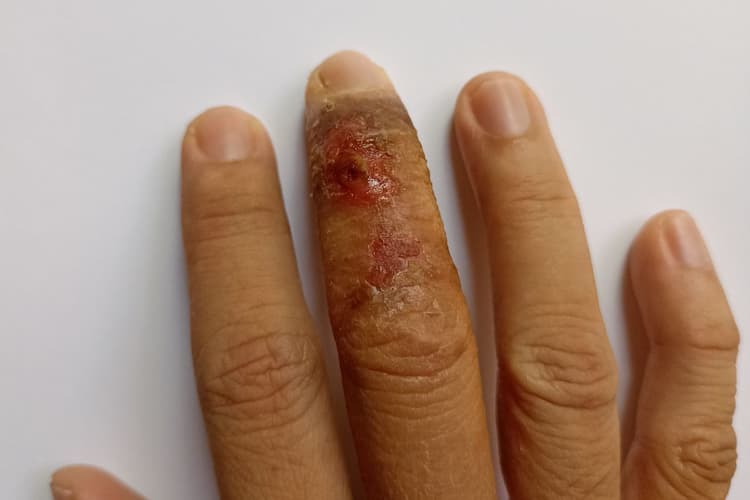 Eczema symptoms: एग्जिमा के कारण और लक्षण को जाने