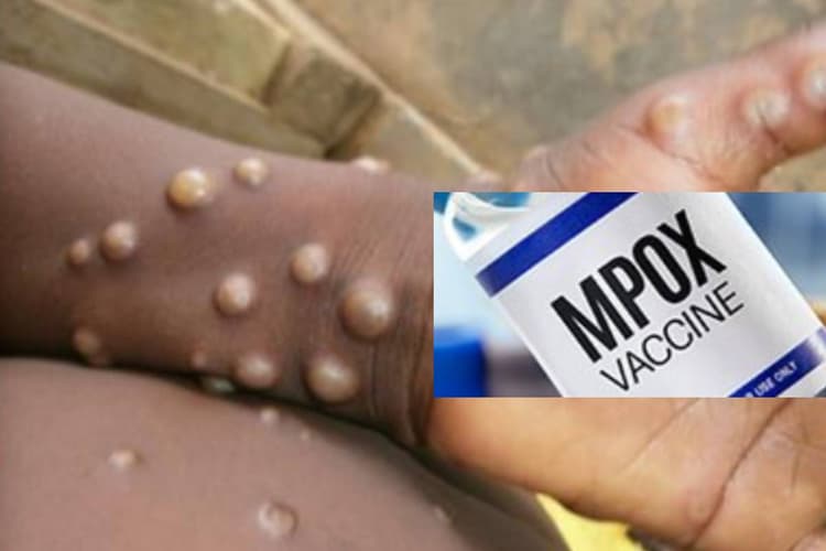 Mpox virus: पहले बुखार फिर चेहरे पर निकलता है दाना, मंकीपॉक्स ने बढ़ा दी दुनिया की टेंशन