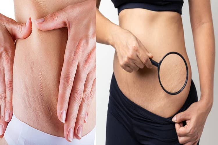 Stretch Marks Remove: प्रेगनेंसी के बाद कैसे हटाएं स्ट्रेच मार्क्स, इन घरेलू चीजों से मिलेगा फायदा
